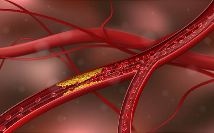 Arterioskleroza Arterioskleroza